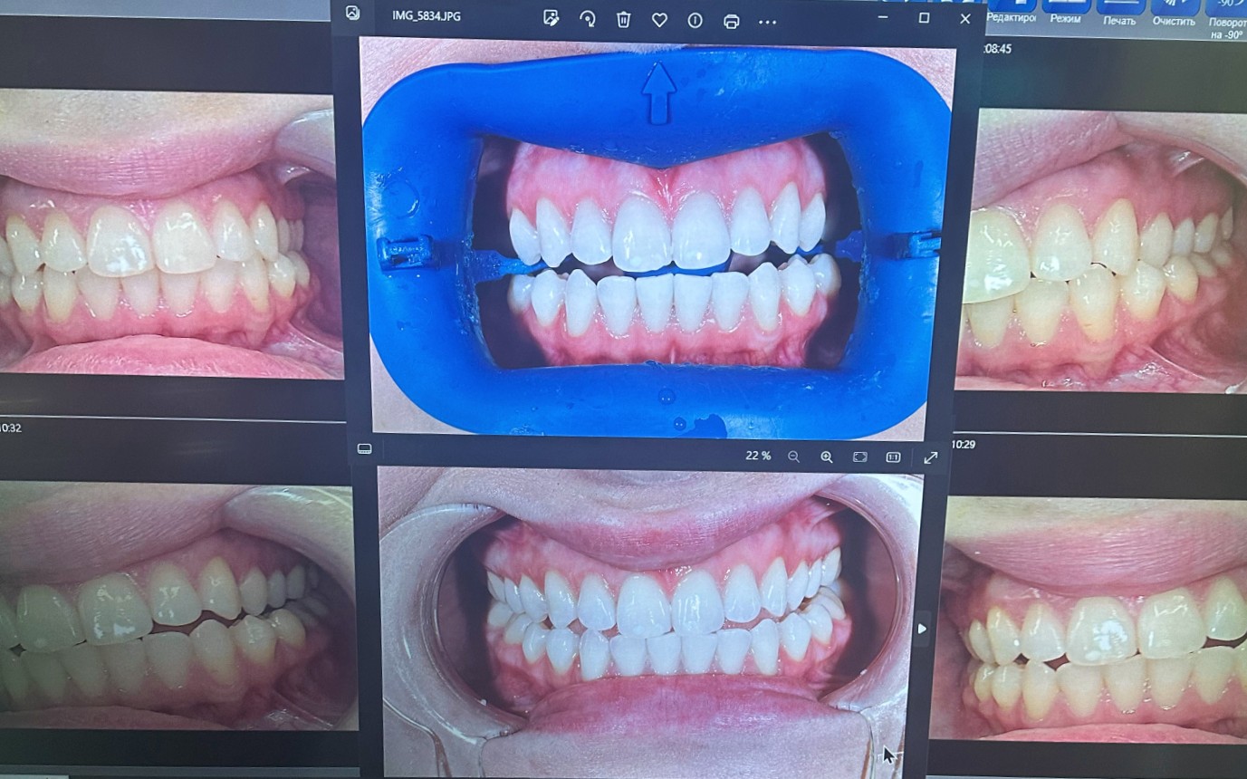 отбеливание зубов zoom фотопротокол до и после